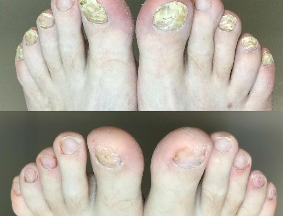 Before and after treatment the fungal cream Promisil