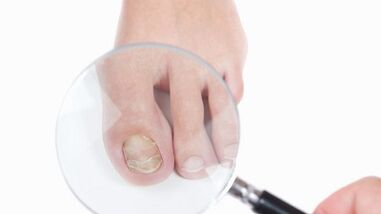 How to treat a fungus on the thumb of the leg