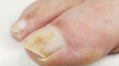 The causes of the fungus of the thumb