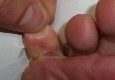 cracked toe due to fungal infection