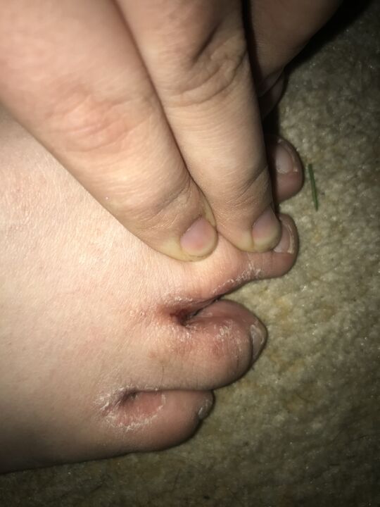 fungal infection of the toes