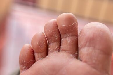 toe fungus symptoms