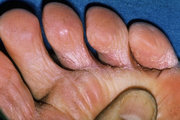 toe fungus