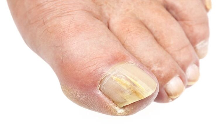 the external change of the nail is a sign of a fungal infection
