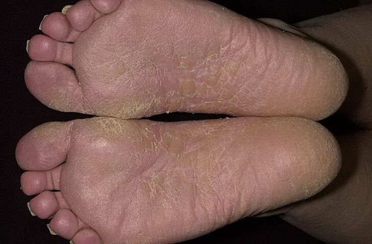 Dry, scaly skin on the feet is a sign of ringworm