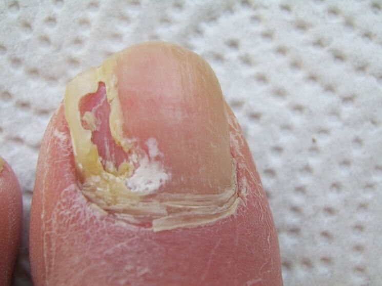 In onychomycosis, a deformation of the nail plate occurs