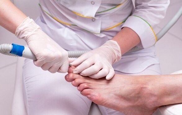 Treatment procedure for toenail fungus